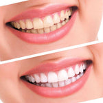 KIT CLAREAMENTO DENTAL - Look produto certo