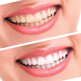 KIT CLAREAMENTO DENTAL - Look produto certo